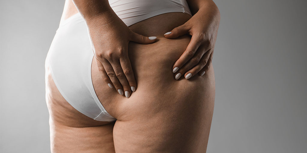 masaje anticelulítico profesional en Madrid