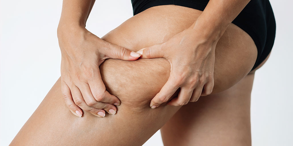 Cómo un masaje anticelulítico profesional puede transformar tu piel