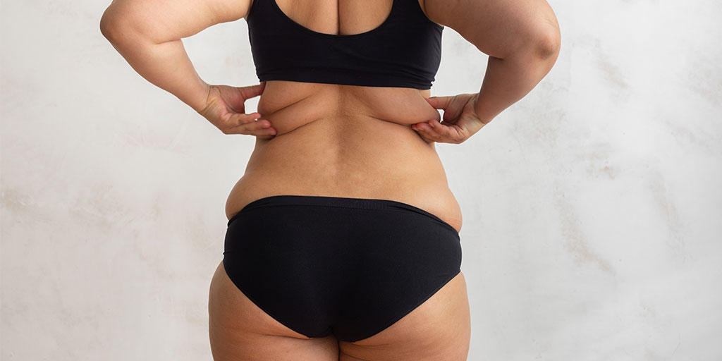 Diferencia entre retención de líquidos y grasa localizada