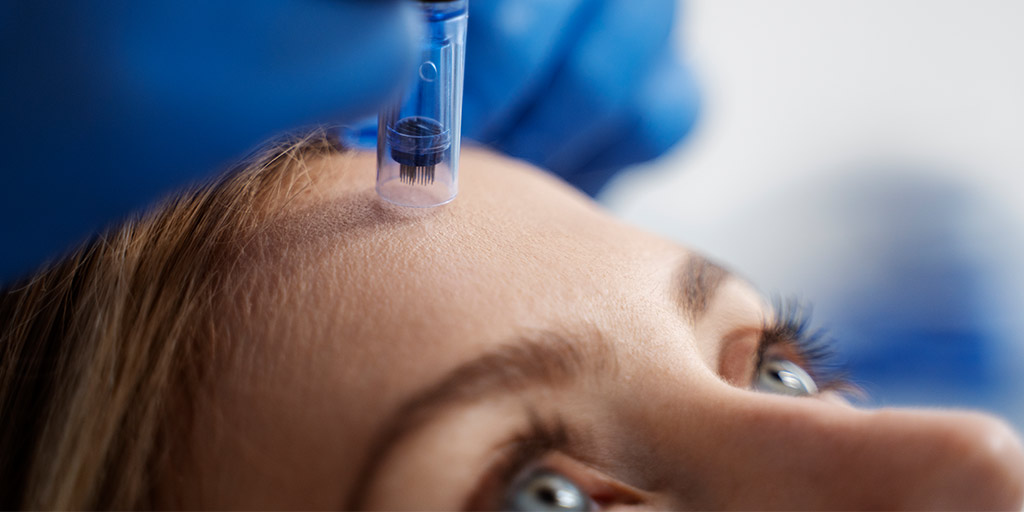 microneeling facial en Madrid