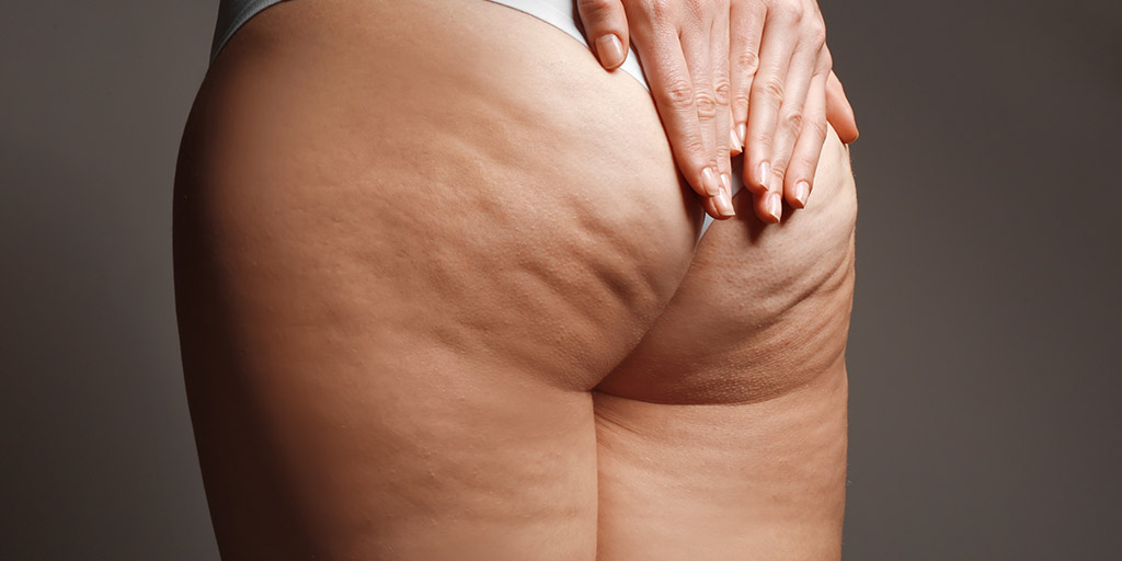 Mejor tratamiento para la celulitis: guía completa para elegir la opción más eficaz