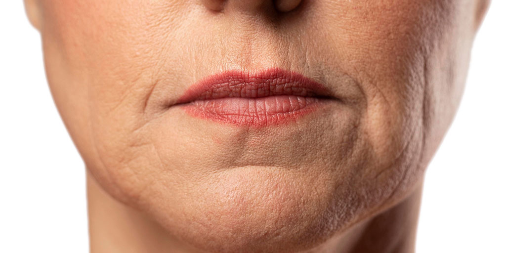 cómo eliminar la flacidez facial